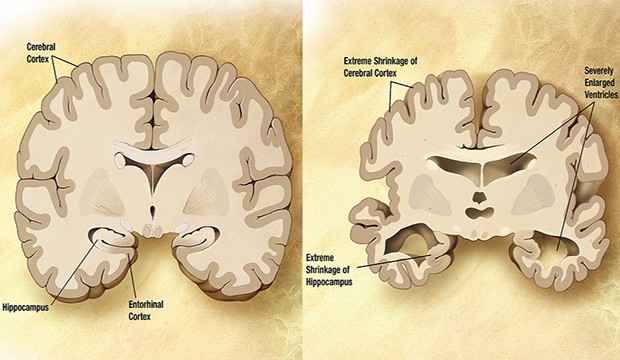 Comparison of a normal aged brain (left) and the brain of a person with Alzheimer's (right) (Wikipedia).