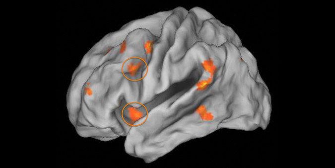 Childhood poverty impacted how much the two regions of the prefrontal cortex (as shown in orange circles) were engaged during emotion regulation.