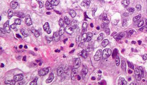 Cervical adenosquamous carcinoma (Nephron).