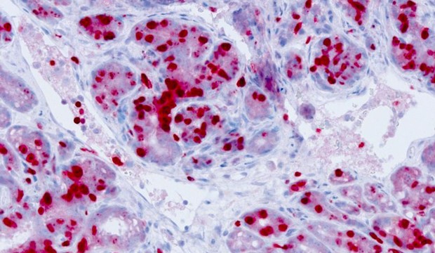 Section of a malignant skin tumor in the multimammate mouse Mastomys coucha. Dividing tumor cells are dyed red (Hermann-Josef Gröne, DKFZ).