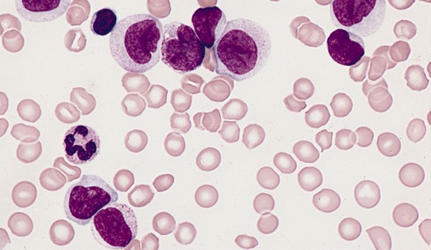 AML (WikimediaCommons).