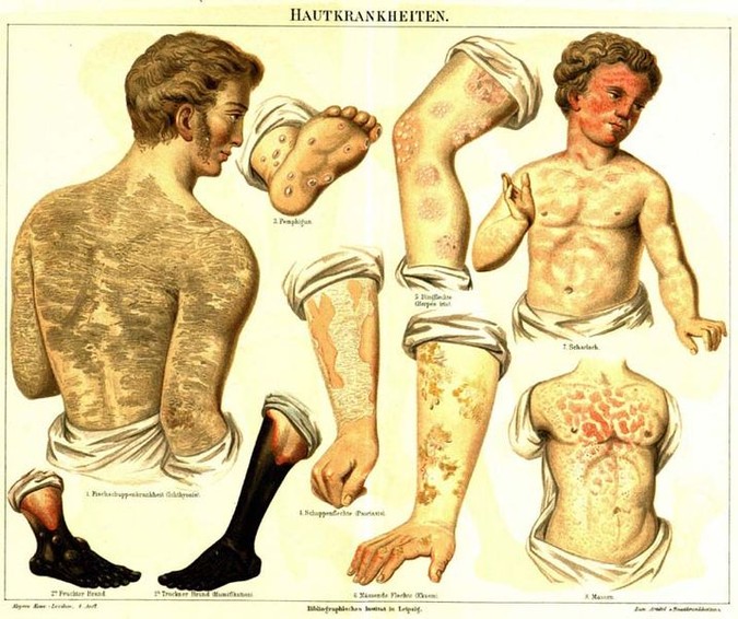Skin diseases, Wikimedia Commons.
Eczema (2nd from right, on the bottom).