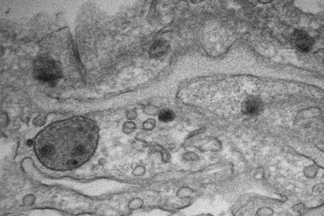 An image taken with an electron microscope shows tumor exosomes in mice lungs.