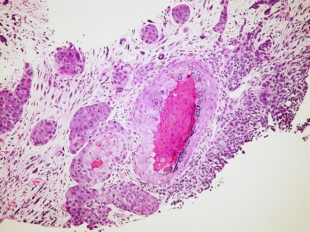 Small cell carcinoma, combined, with squamous cell carcinoma Case 119 (Yale Rosen, Flickr).