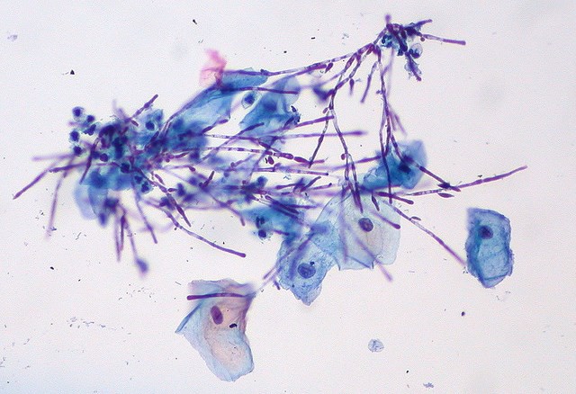 Candida, Liquid-based Pap (Ed Uthman, Flickr).