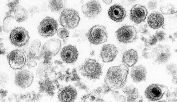 epstein-barr-virus_dkfz_1.jpg