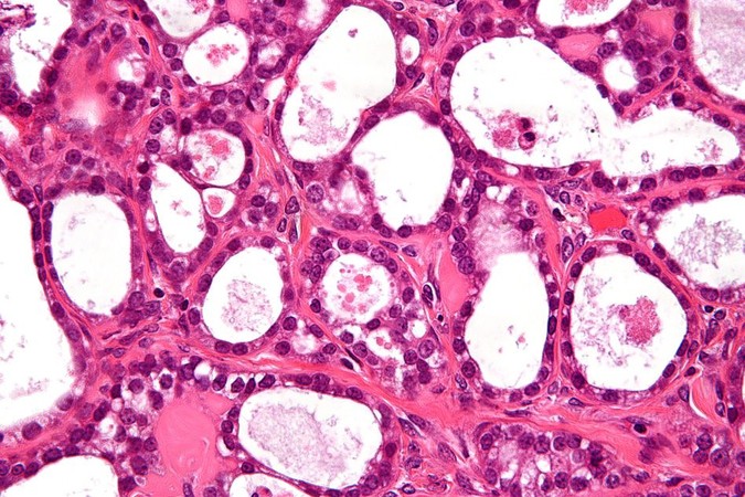 MIT-Ovarian-Cancer.jpg