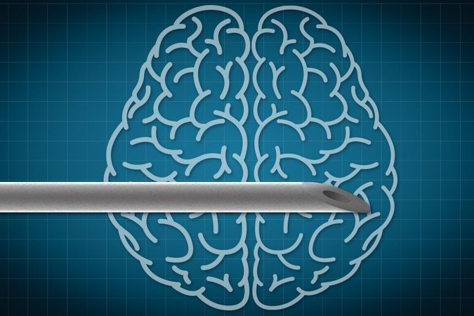 MIT-brain-implant.jpg