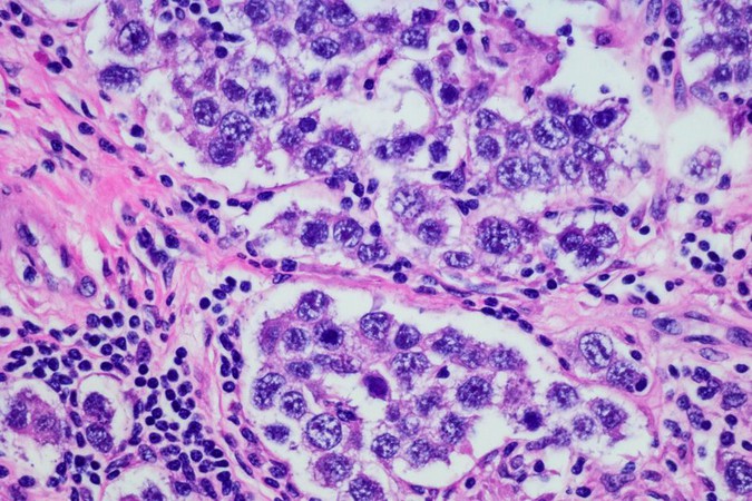 MIT-Ovarian-Cancer_1.jpg