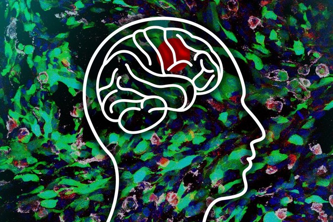 MIT-Glioblastoma-1.jpg