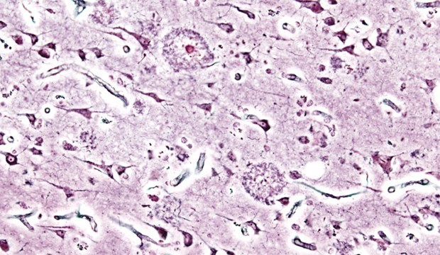 Alzheimer_plaques_1_wikipedia.jpg