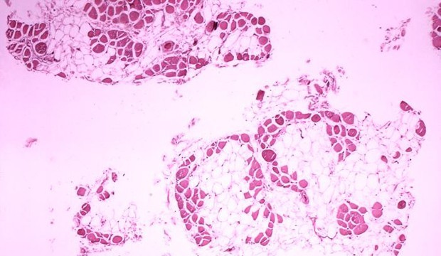 Duchenne-muscular-dystrophy.jpg