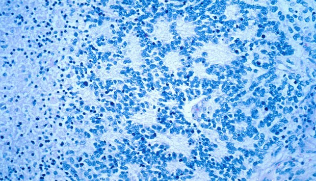 Neuroblastoma_rosettes.jpg