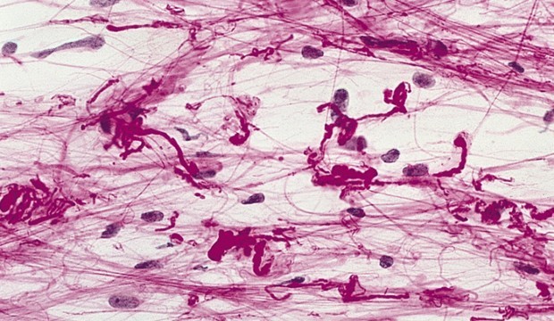 Rosenthal_fibers_1.jpg