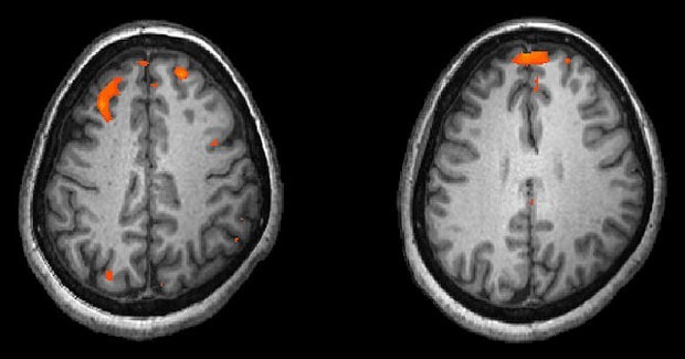Schizophrenia_wikipedia_1.jpg