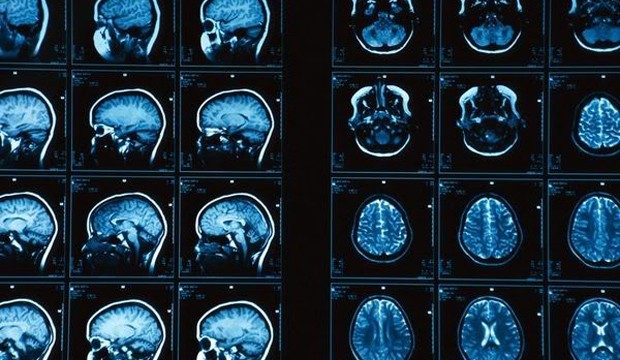 brain-mri_1_photobucket.jpg