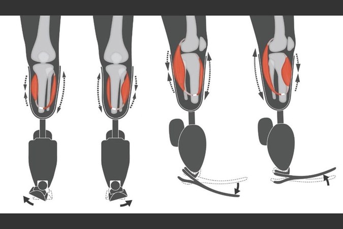 MIT-Bionic-Surgery.jpg