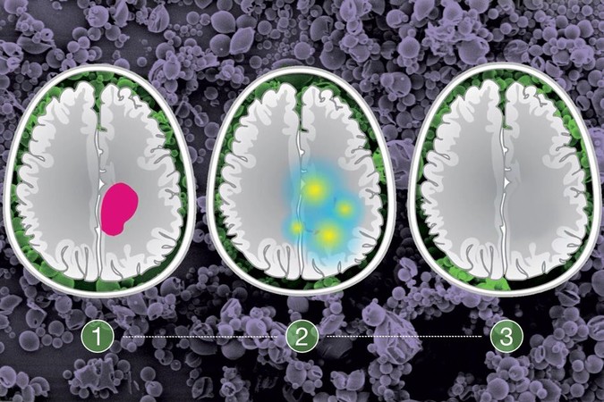 MIT-Glioma-Treatment-01.jpg