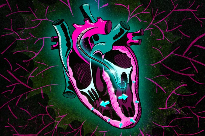 MIT-Ventricular-Assist-01-press.jpg
