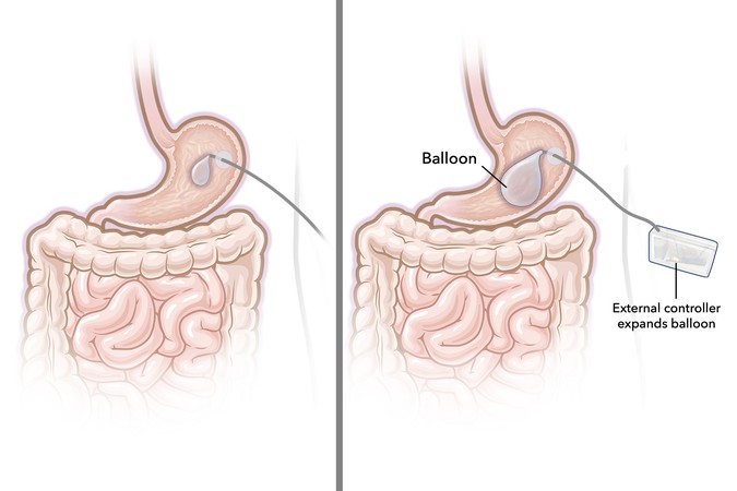MIT-Gastric-Balloon-01-press.jpg
