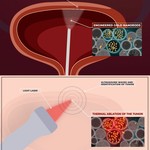 PHIRE_ultrasound waves and identification of tumour.jpg
