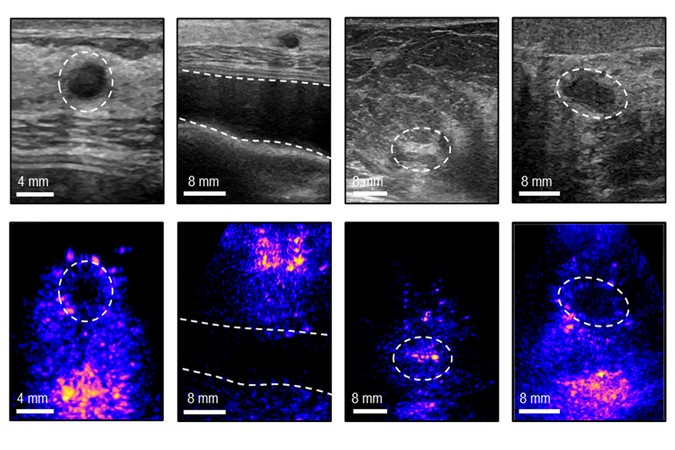 MIT-CancerUltrasound-01-press.jpg